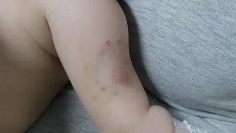 Imagen de los hematomas del bebé Imagen de los hematomas del bebé