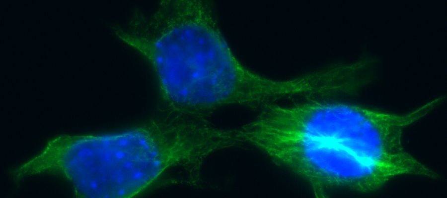 Células de cáncer de mama Células de cáncer de mama