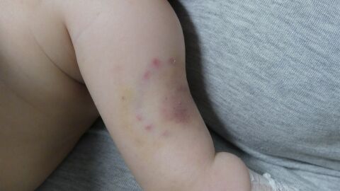 Hematomas que presentaba el ni&ntilde;o supuestamente maltratado por sus padres.
