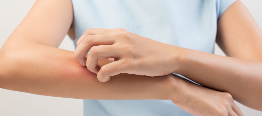 Quemadura en un brazo Quemadura en un brazo