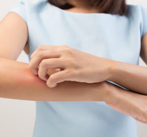Quemadura en un brazo Quemadura en un brazo