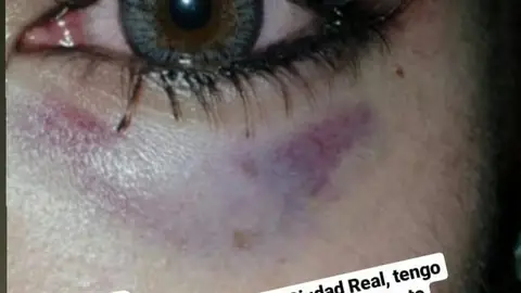 La joven subió a Twitter una foto en la que muestra los daños que sufrió en un ojo La joven subió a Twitter una foto en la que muestra los daños que sufrió en un ojo