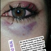 La joven subió a Twitter una foto en la que muestra los daños que sufrió en un ojo