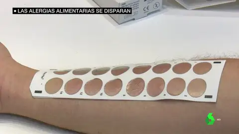 Las alergias alimentarias se disparan: ya afecta a un 11% de la población Las alergias alimentarias se disparan: ya afecta a un 11% de la población