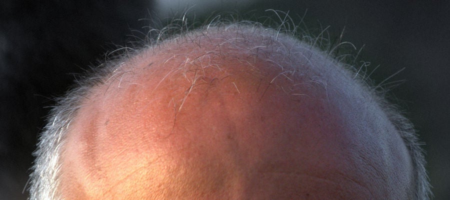 La calvicie es una de las enfermedades más extendidas, sobre todo entre los hombres La calvicie es una de las enfermedades más extendidas, sobre todo entre los hombres