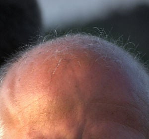 La calvicie es una de las enfermedades más extendidas, sobre todo entre los hombres La calvicie es una de las enfermedades más extendidas, sobre todo entre los hombres