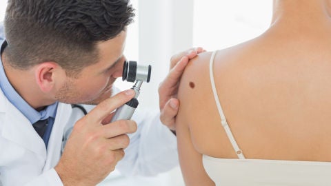 Prevención de melanoma