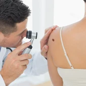 Prevención de melanoma Prevención de melanoma