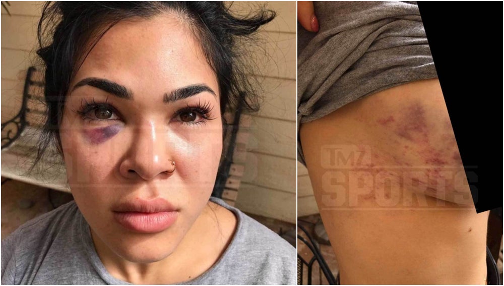 Rachael Ostovich, luchadora de la UFC, publica las fotos tras la brutal agresión de su marido Rachael Ostovich, luchadora de la UFC, publica las fotos tras la brutal agresión de su marido