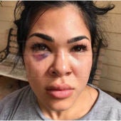 Rachael Ostovich muestra sus heridas tras la agresión de su marido