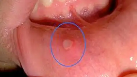 Aftas bucales La Farmacia en Casa