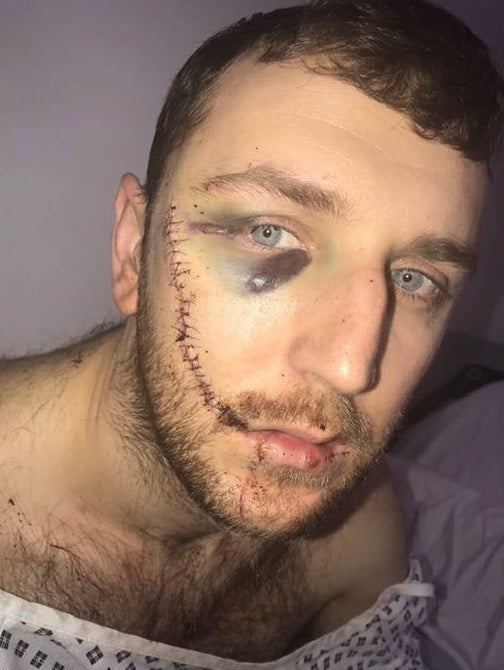 Las terribles heridas de un seguidor del Everton al que rajaron la cara en una pelea entre hooligans: "No me puedo mirar en el espejo" Las terribles heridas de un seguidor del Everton al que rajaron la cara en una pelea entre hooligans: "No me puedo mirar en el espejo"