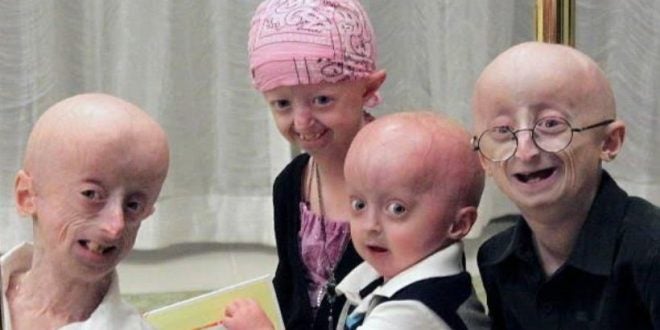 Hallan un tratamiento para frenar la progeria, el envejecimiento prematuro Hallan un tratamiento para frenar la progeria, el envejecimiento prematuro