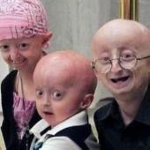 Hallan una terapia contra la progeria, la enfermedad que envejece a los niños