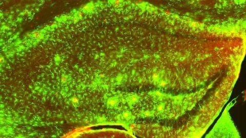 astrocitos reactivos en las zonas de patolog&iacute;a