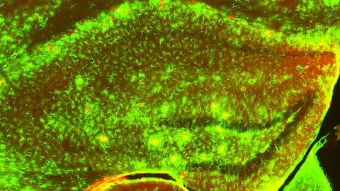 astrocitos reactivos en las zonas de patología astrocitos reactivos en las zonas de patología