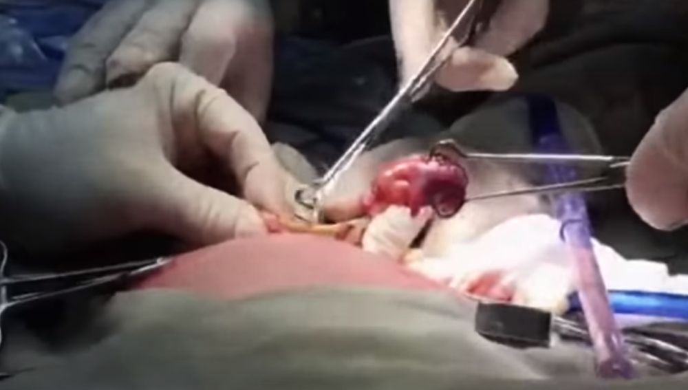 Operación para extraer el feto a la bebé