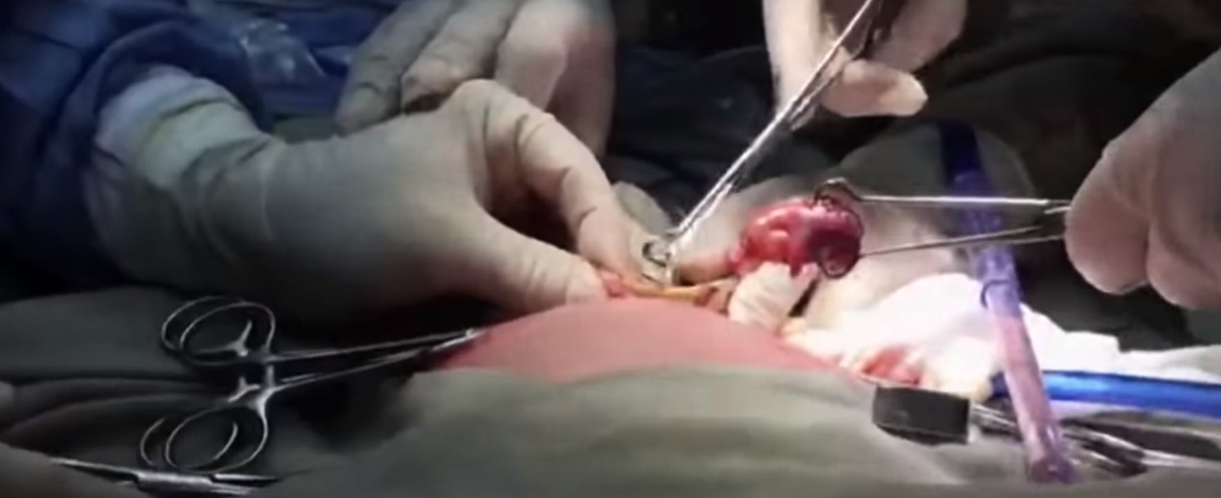 Practican una cesárea a una recién nacida que tenía en su útero un feto sin desarrollar Practican una cesárea a una recién nacida que tenía en su útero un feto sin desarrollar