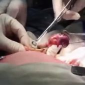 Operación para extraer el feto a la bebé