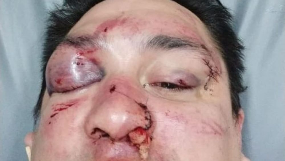 El periodista Sebastián Acosta, tras ser agredido