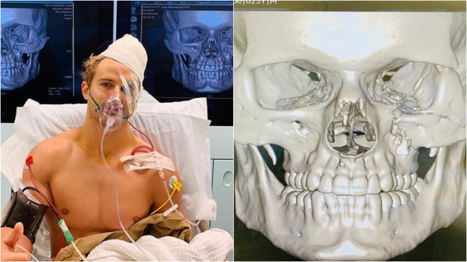 El terrible ko en la ONE Championship que pudo acabar en desgracia: "Ocho fracturas y nueve horas de intensa operación" El terrible ko en la ONE Championship que pudo acabar en desgracia: "Ocho fracturas y nueve horas de intensa operación"
