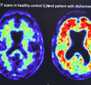 Pfizer ocultó que uno de sus fármacos contra la artritis podría prevenir el Alzheimer Pfizer ocultó que uno de sus fármacos contra la artritis podría prevenir el Alzheimer