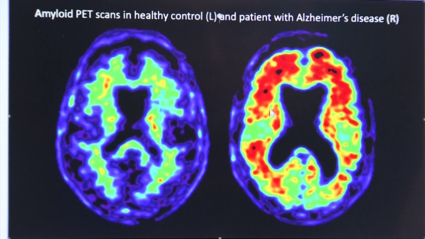 El gigante farmaceútico Pfizer ocultó que uno de sus fármacos podría prevenir el Alzheimer El gigante farmaceútico Pfizer ocultó que uno de sus fármacos podría prevenir el Alzheimer