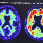 Pfizer ocultó que uno de sus fármacos contra la artritis podría prevenir el Alzheimer