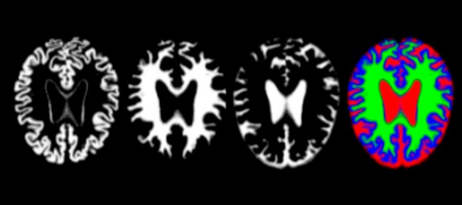 imágenes de resonancia de cerebros con alzhéimer imágenes de resonancia de cerebros con alzhéimer