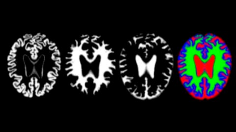 im&aacute;genes de resonancia de cerebros con alzh&eacute;imer