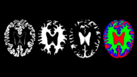 Imágenes de resonancia de cerebros con alzhéimer imágenes de resonancia de cerebros con alzhéimer