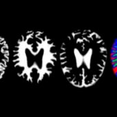 imágenes de resonancia de cerebros con alzhéimer