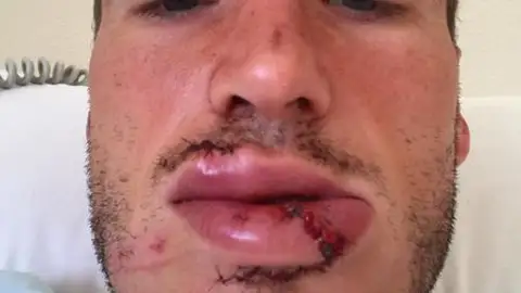 Álex Bergantiños tras ser operado. Álex Bergantiños tras ser operado.