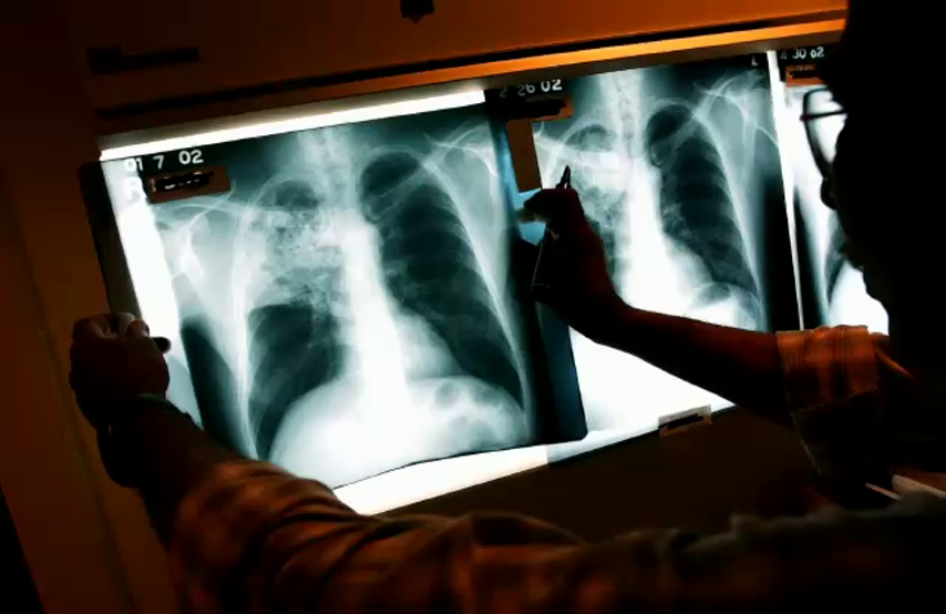 Un hombre se traga su propia dentadura postiza y se da cuenta varios días después Un hombre se traga su propia dentadura postiza y se da cuenta varios días después