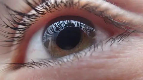 Una nueva lente intraocular del CSIC se prueba en pacientes con cataratas Una nueva lente intraocular del CSIC se prueba en pacientes con cataratas
