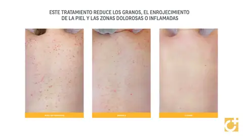 Centro Dermatológico Estético Acne