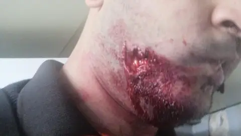 Imagen de un mordisco a un guardia de Seguridad en el metro de Barcelona Imagen de un mordisco a un guardia de Seguridad en el metro de Barcelona
