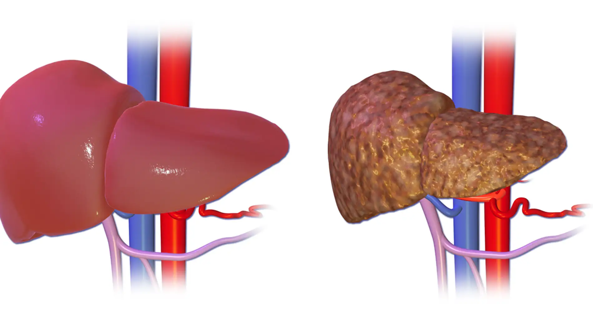 El hígado normal comparado con un hígado con cirrosis.