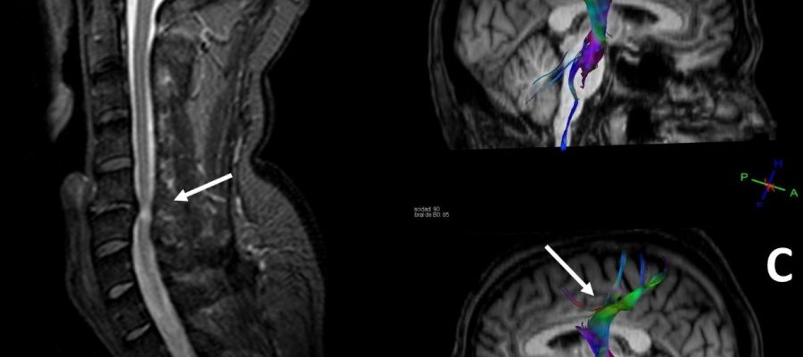 Imagen con la compresión de la médula espinal y su efecto en el cerebro. Imagen con la compresión de la médula espinal y su efecto en el cerebro.
