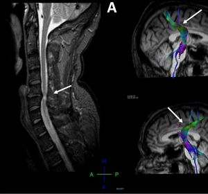 Imagen con la compresión de la médula espinal y su efecto en el cerebro. Imagen con la compresión de la médula espinal y su efecto en el cerebro.