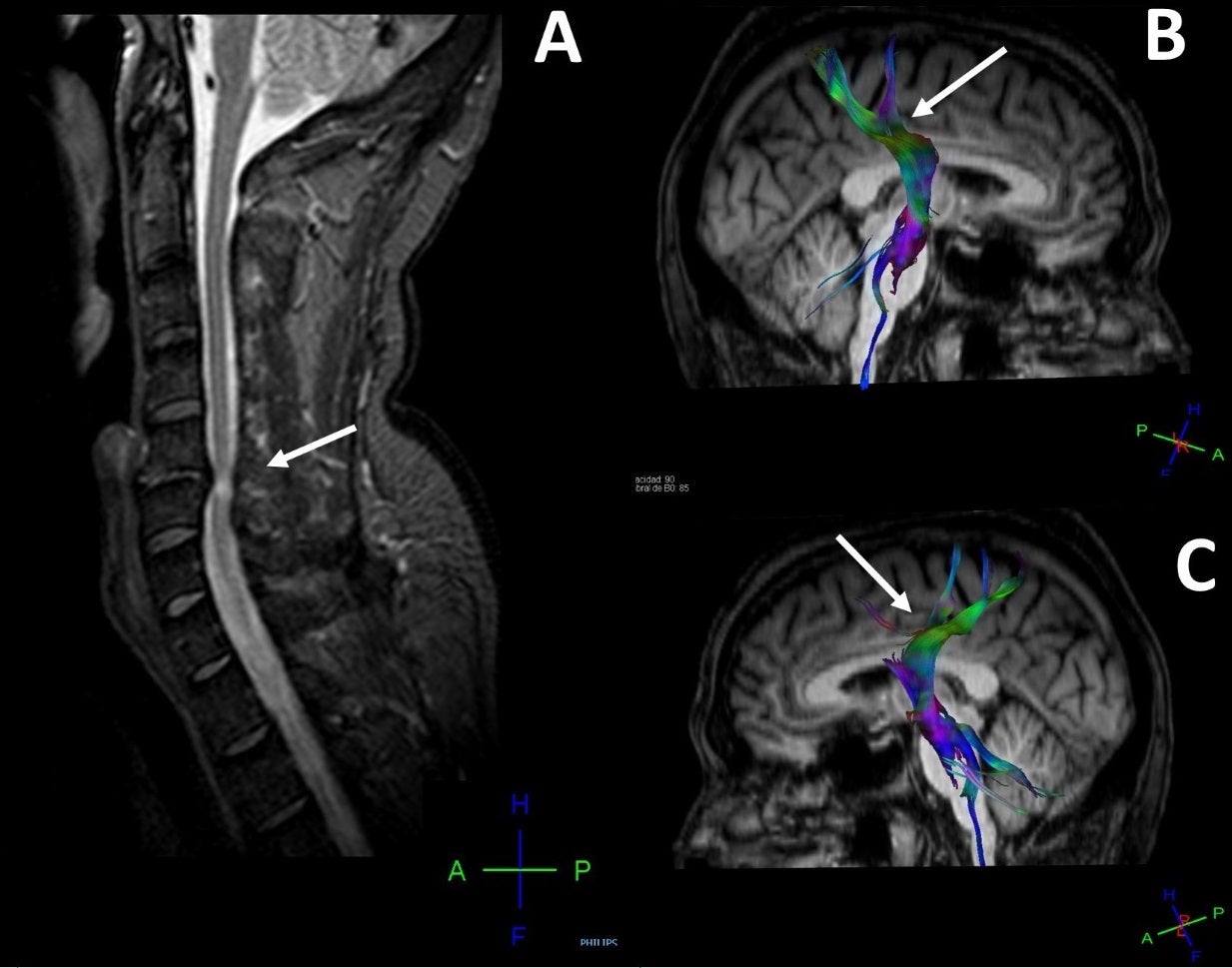 Un estudio de la UMH de Elche constata que los efectos de las hernias cervicales pueden producir daños a nivel cerebral Un estudio de la UMH de Elche constata que los efectos de las hernias cervicales pueden producir daños a nivel cerebral