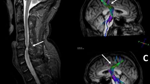 Imagen con la compresi&oacute;n de la m&eacute;dula espinal y su efecto en el cerebro.