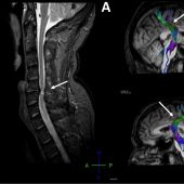 Imagen con la compresión de la médula espinal y su efecto en el cerebro.