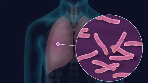 Imagen de la bacteria Mycobacterium tuberculosis Imagen de la bacteria Mycobacterium tuberculosis