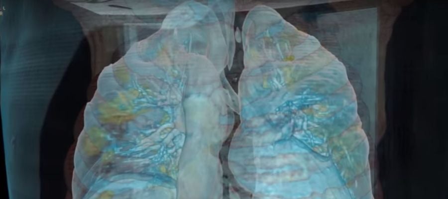 Imagen de unos pulmones afectados por coronavirus. Imagen de unos pulmones afectados por coronavirus.