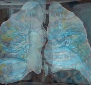 Imagen de unos pulmones afectados por coronavirus. Imagen de unos pulmones afectados por coronavirus.