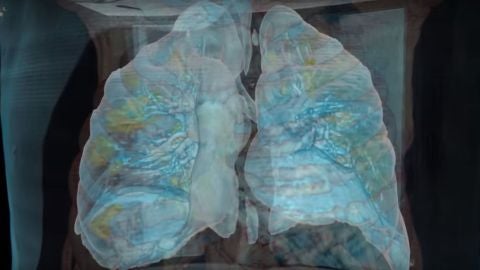 Imagen de unos pulmones afectados por coronavirus (Archivo)