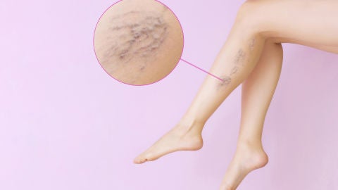 Tratamiento en el Centro Dermat&oacute;logico Est&eacute;tico