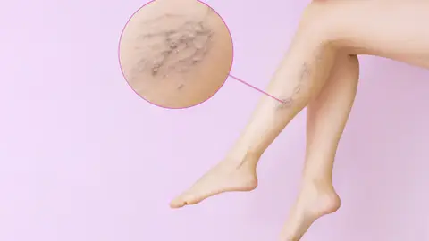 Tratamiento en el Centro Dermatólogico Estético Tratamiento en el Centro Dermatólogico Estético