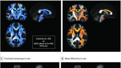 Estructura del cerebro en la adicci&oacute;n.